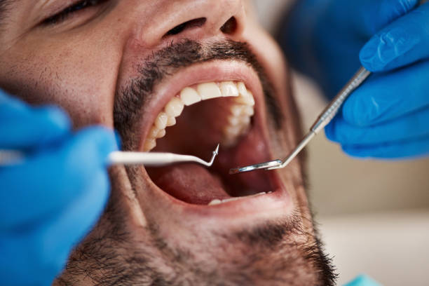 Best Emergency Wisdom Teeth Removal in Napili Honokowai, HI