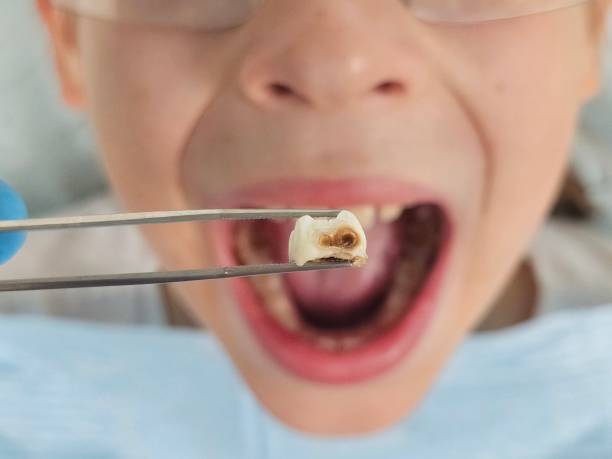 Best Emergency Tooth Extraction in Napili Honokowai, HI